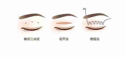 点式双眼皮