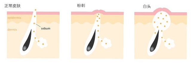 丘疹型痘痘摸着会疼吗