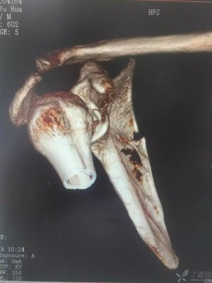 肩胛骨骨折怎么治疗