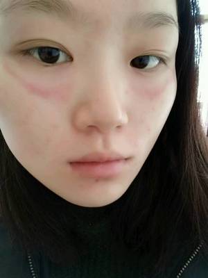 眼睛周围红是怎么回事