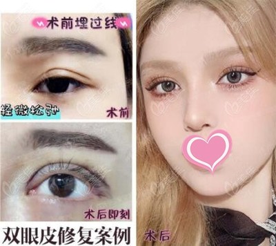 失败双眼皮修复贴吧
