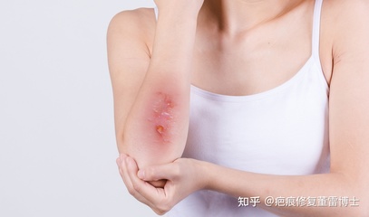 怎么判断自己是疤痕体质