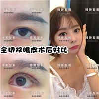 在切双眼皮多少价格