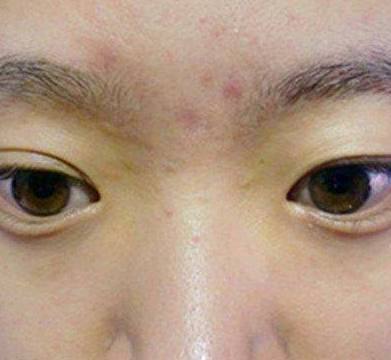 左眼眉毛长痘痘