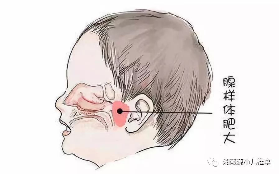 宝宝腺体肥大