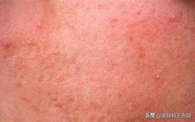痘痘怎么一直消不下去