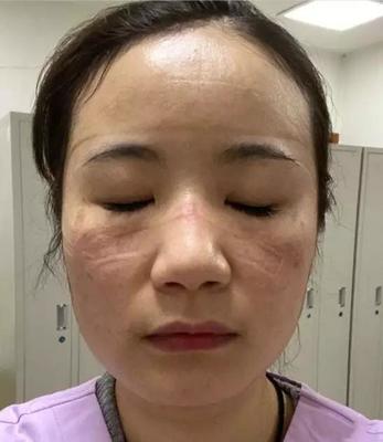 脸部发热是怎么回事