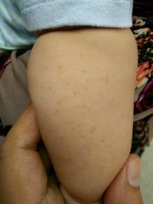打完婴儿针起痘痘