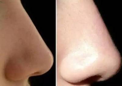 用牙膏涂痘痘要敷多久