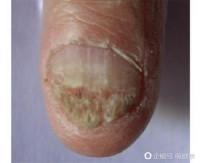 指甲破裂是怎么回事
