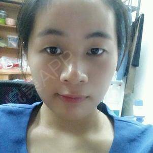 痘痘怎么消除江城皮肤可以