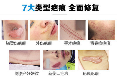 治疗疤痕最好的方法