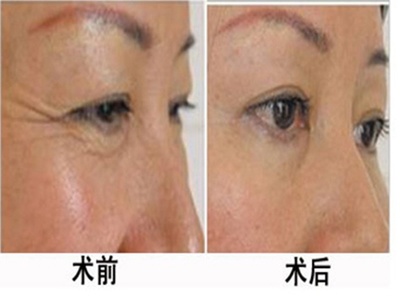 鱼尾纹除皱方法