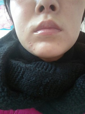 脸上好多痘印痘痘可以用维e吗