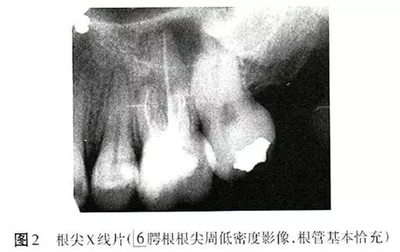 承德市根管治疗多少钱一颗