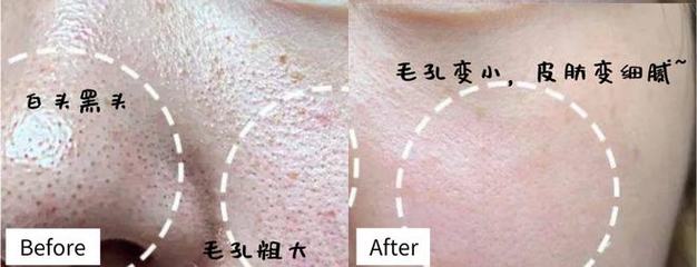 怎么可以让毛孔变小