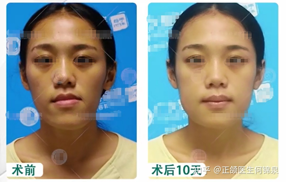 脸型不正左右脸不对称
