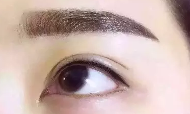 怎么拥有双眼皮