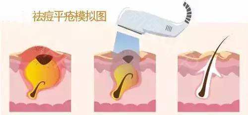 皮秒激光可以祛痘印吗