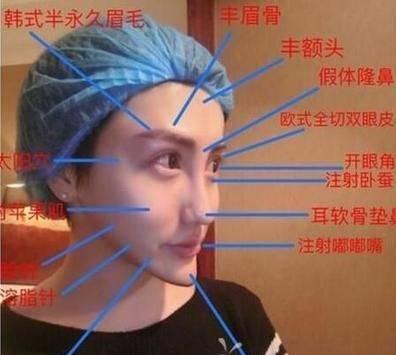 耳软骨隆鼻是永久的吗