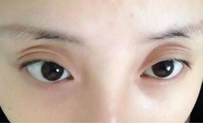 双眼皮不明显咋办