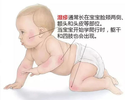 宝宝湿疹怎么弄