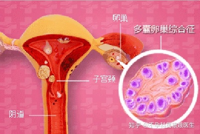 卵巢多囊样改变怎么治疗