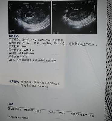 宫腔积血是怎么回事