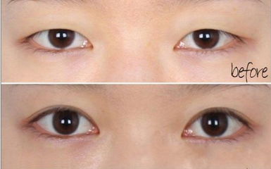 割双眼皮需要多久恢复
