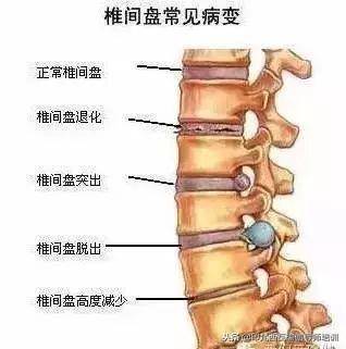 腰椎膨出是膨出多少