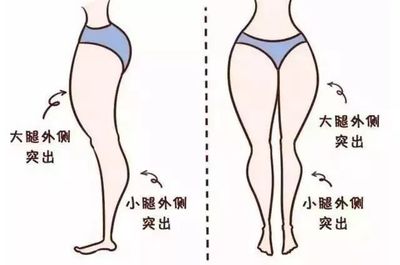 大腿抽脂减肥的费用