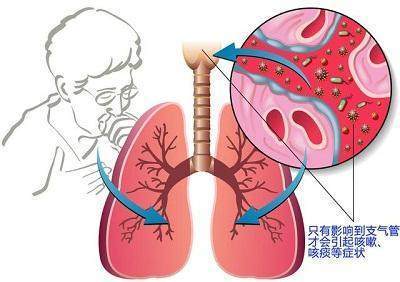肺结节是怎么回事