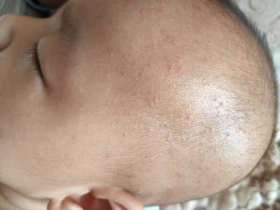 打完婴儿针起痘痘