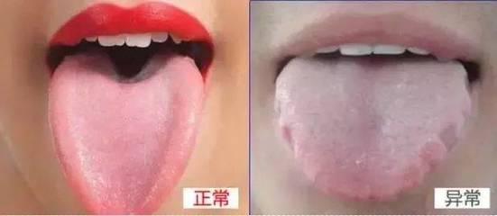舌苔没了是怎么回事
