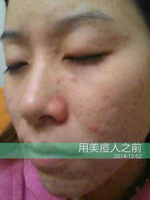 痘痘一个月了