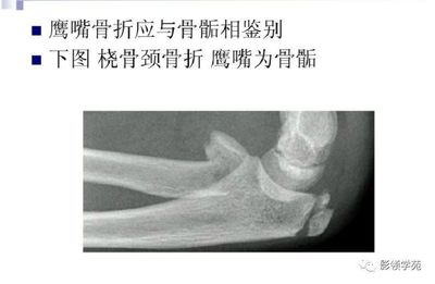 骨颈骨折后几个月能好