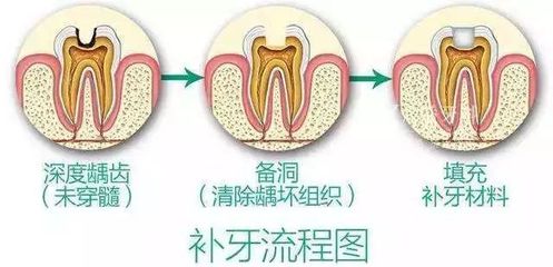 补牙注意