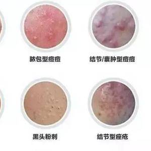 结节型痘痘怎么去