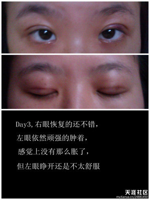 双眼皮太肿