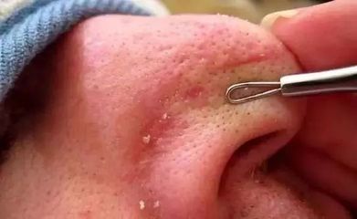 挤黑头毛孔粗大怎么办