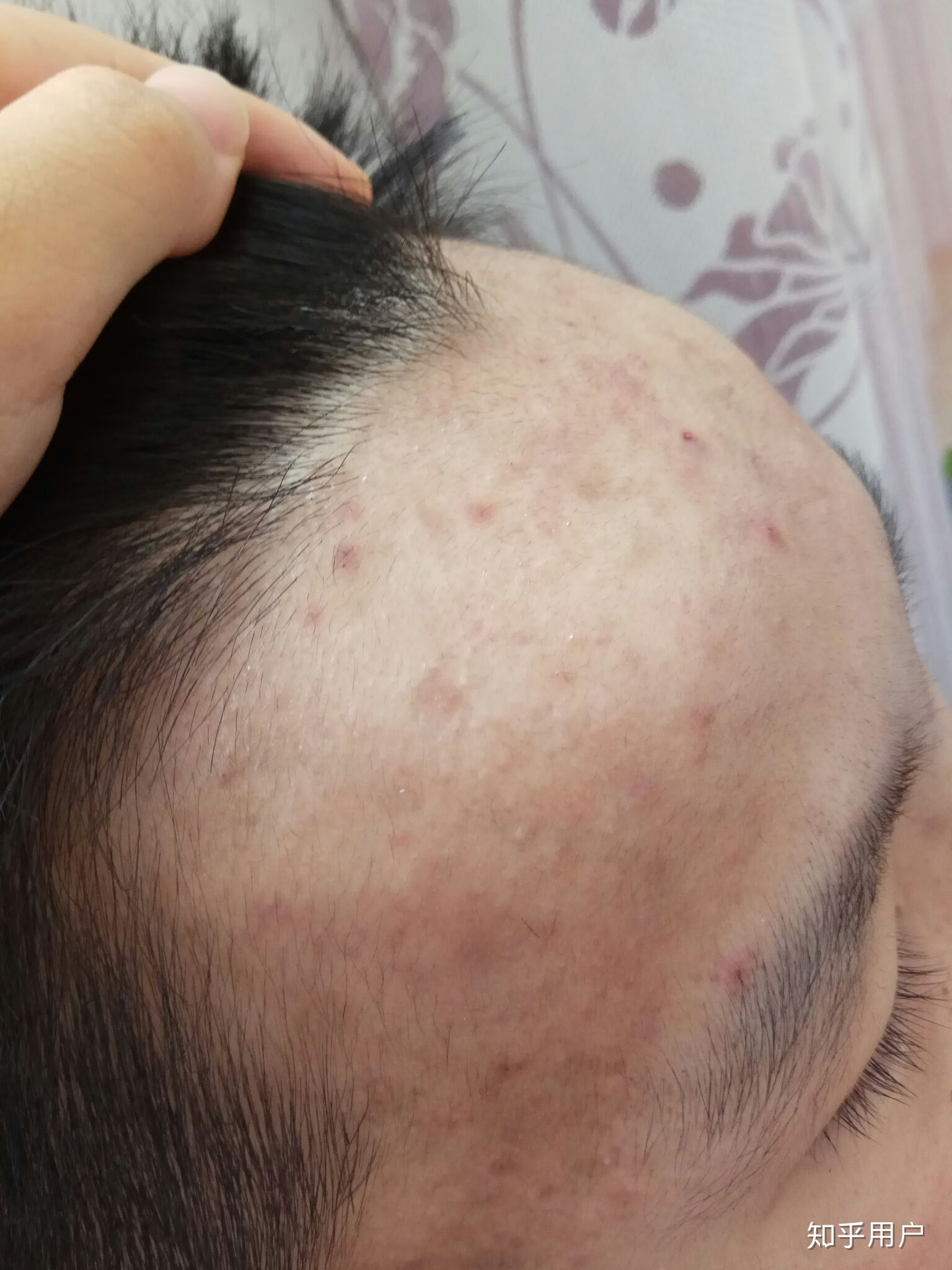 脸上痘痘留下的斑怎么办