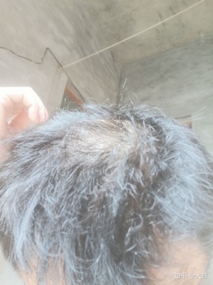 男生爱掉头发是怎么回事