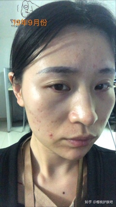 涂粉刺痘痘的药膏