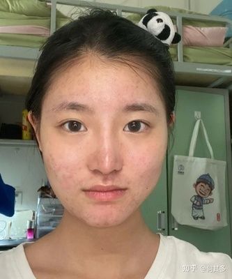 满脸痘印