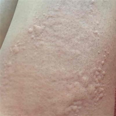 孕妇荨麻疹如何治疗