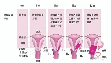 宫颈高危病毒怎么治疗
