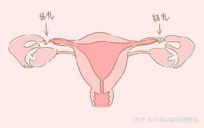 取环后是不是很难怀孕