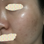 水光针治痘痘有用吗