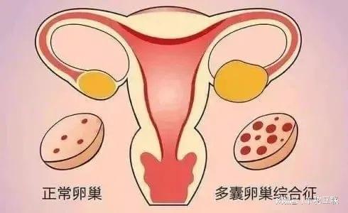 多囊会影响怀孕吗