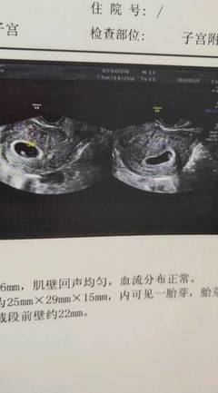 刚怀孕一周会恶心吗